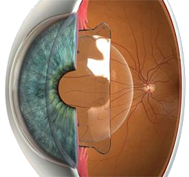 Immediate vision improvement
